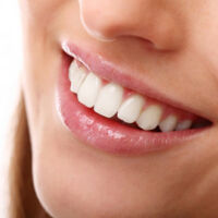 تبييض الأسنان / Teeth Whitening